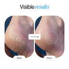 20% Urea Foot and Heel Roll On (50ml)