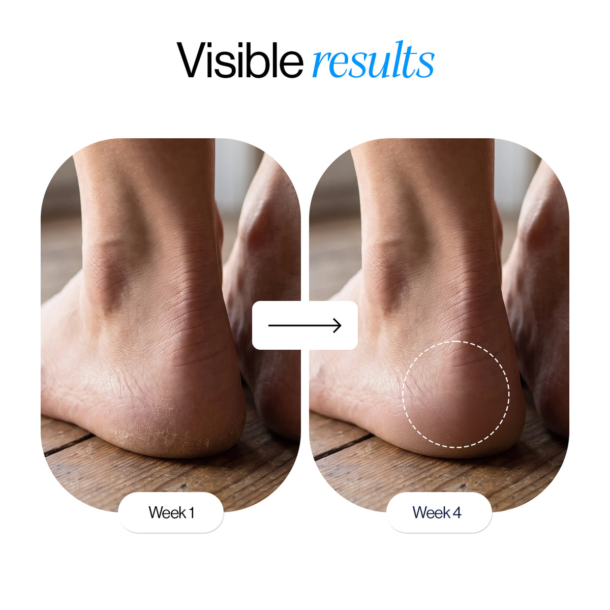 20% Urea Foot and Heel Roll On (50ml)