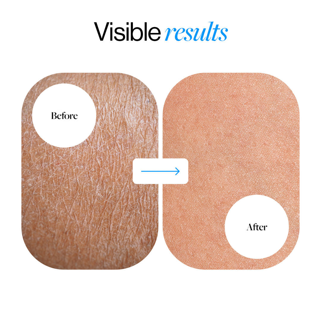 10% Urea Body Lotion